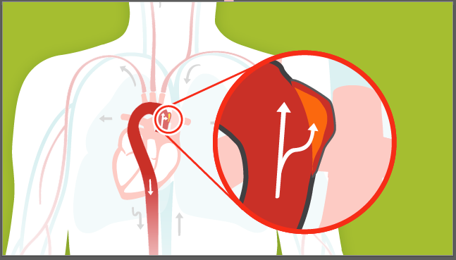 Aortic aneurysm image